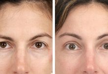 here's-what-to-expect-after-a-thread-lift-for-eyebrows