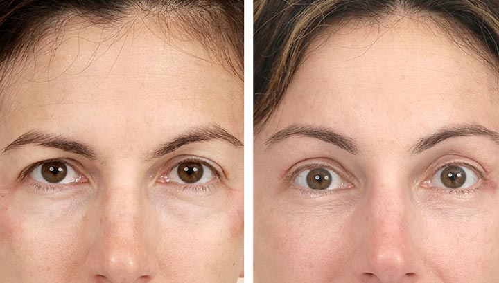 here's-what-to-expect-after-a-thread-lift-for-eyebrows
